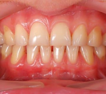 gingivitis-670x446