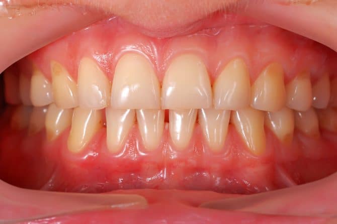 gingivitis-670x446