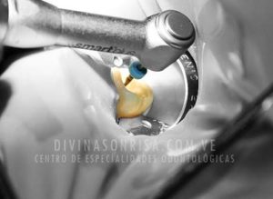 endodoncia-divina-sonrisa