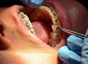 ortodoncia-divina-sonrisa